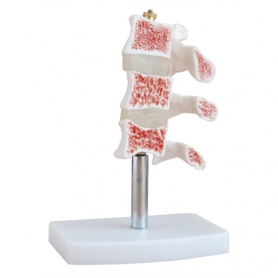 切開(kāi)型骨質(zhì)疏松癥